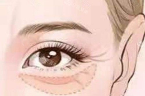 眼袋整形卡通图 眼袋整形卡通图