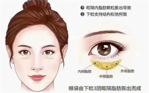 眼袋详细介绍动画图 眼袋详细介绍动画图