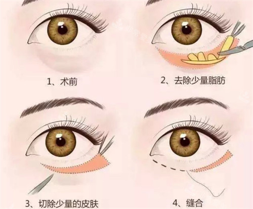 外切祛眼袋手术过程 外切祛眼袋手术过程