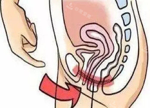 女性私密整形位置示意图 女性私密整形位置示意图