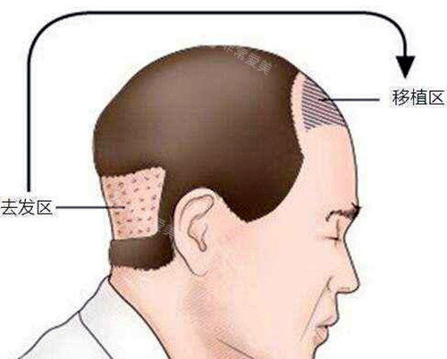 毛发移植图示