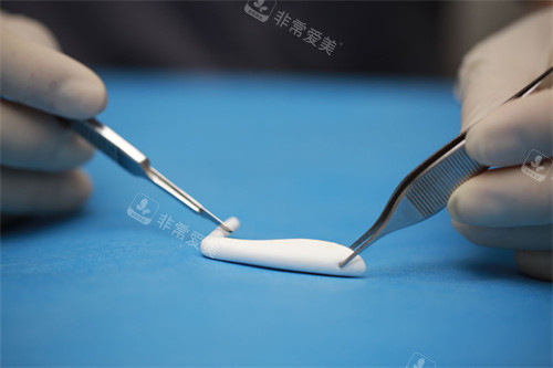 隆鼻手术中使用的膨体 隆鼻手术中使用的膨体