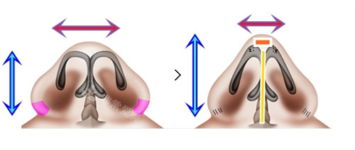 鼻翼缩小加隆鼻手术对比 鼻翼缩小加隆鼻手术对比
