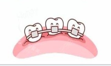 隐形牙齿和传统牙齿矫正器展示图