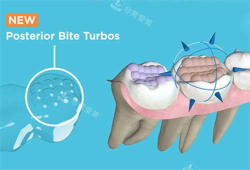 Spark精靓隐形矫正器后牙涡轮