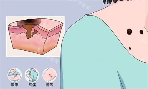 黑色素瘤的样子