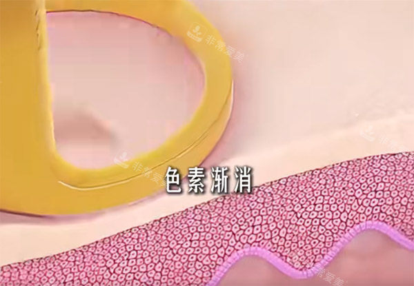 调Q激光改善黑色素