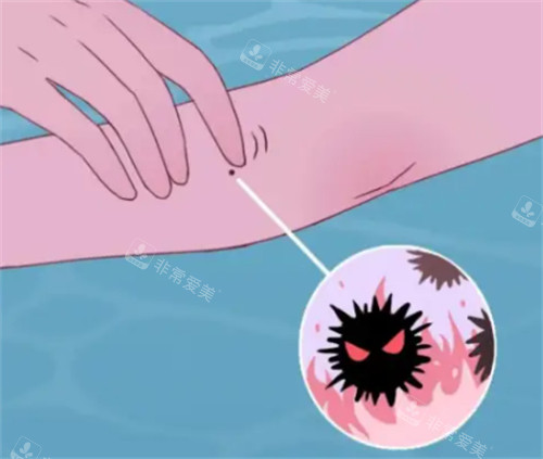 黑色素瘤怎么回事