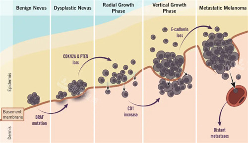 不同程度黑色素瘤