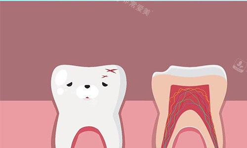 根管治疗的流程示意图