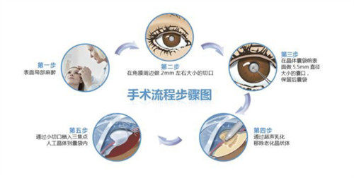 白内障三焦点人工晶体手术过程