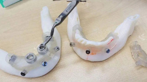 种植牙导板3D打印.webp