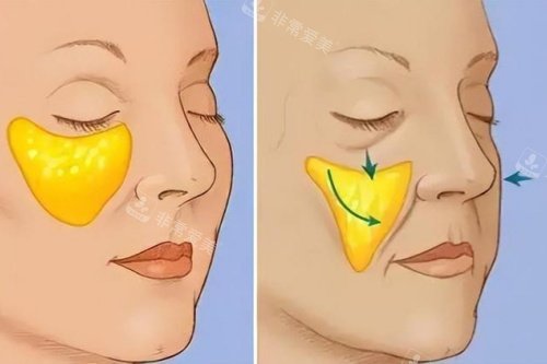 苹果肌下垂于正常苹果肌卡通对比图