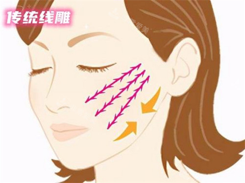 苹果肌线雕提升术动画演示图 苹果肌线雕提升术动画演示图