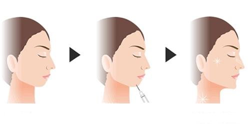 玻尿酸豐下巴示意圖