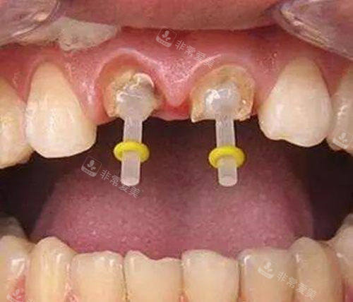牙齿打桩示意图