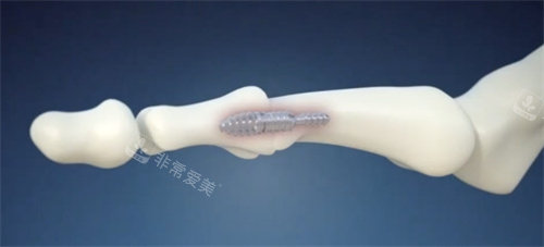 脚趾矫正手术内部固定