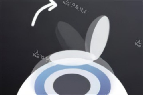 半飞秒掀开角膜瓣