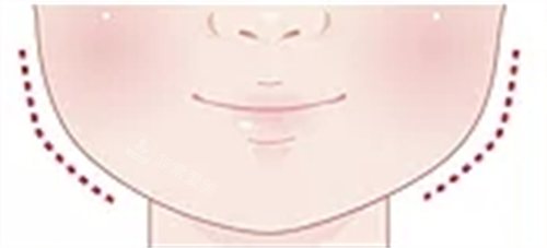 韩国轮廓手术和国内区别：我的塑美经历，告诉你真实差距在哪