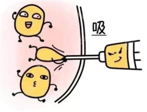 吸脂手术动画 吸脂手术动画