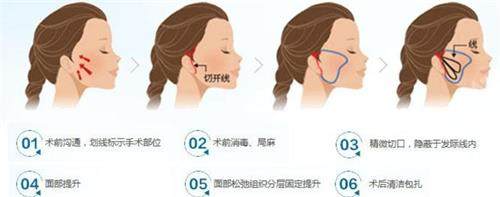 网评北京拉皮医生排行...