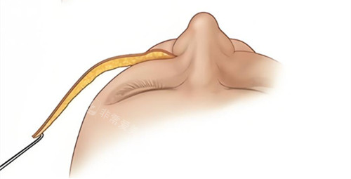 网评北京拉皮手术医生...