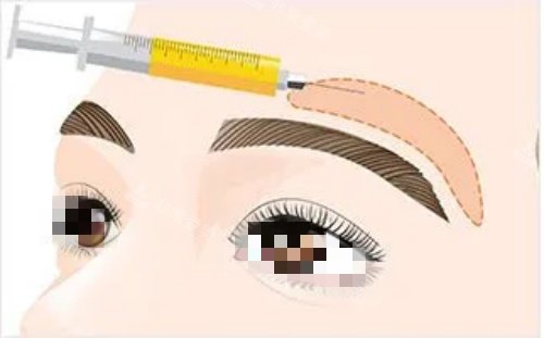 膨体眉弓操作示意图