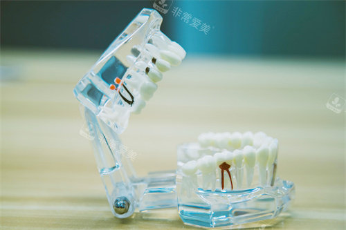 根管治疗牙齿模型