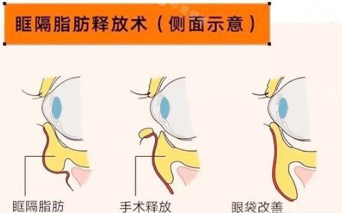 眶隔脂肪祛眼袋