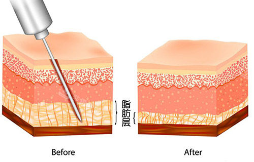重庆做吸脂手术靠谱医...