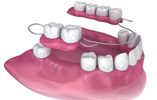 可移动部分假牙