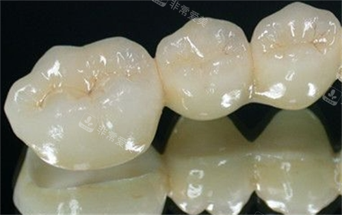 全瓷牙模型展示