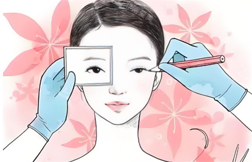 双眼皮手术过程 双眼皮手术过程