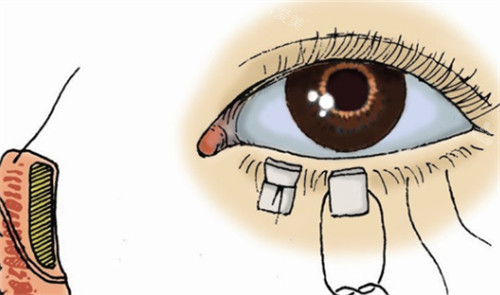 下眼睑外翻修复过程 下眼睑外翻修复过程