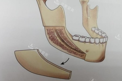 下颌角截骨卡通图 下颌角截骨卡通图