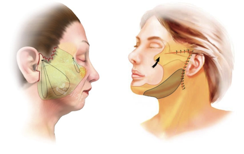 郑州拉皮手术多少钱?我找宋连成医生报价4.2W,大家帮我看看值不值!