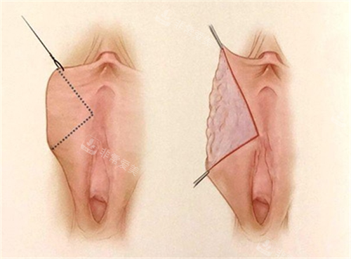女性私密手术动画展示