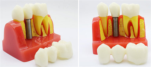 种植牙模具 图片