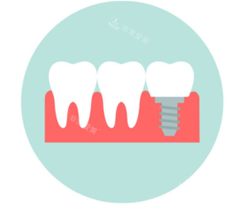 种植牙模拟卡通图