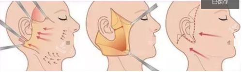 手术除皱示意图