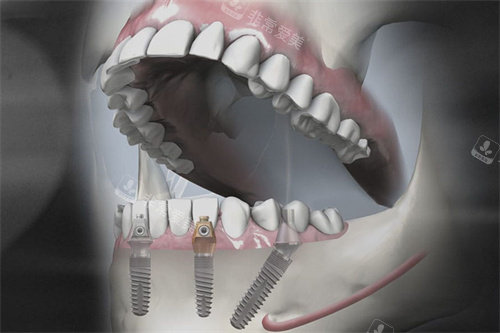 德国SKY种植牙模拟图
