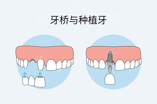 牙冠桥和种植牙对比图