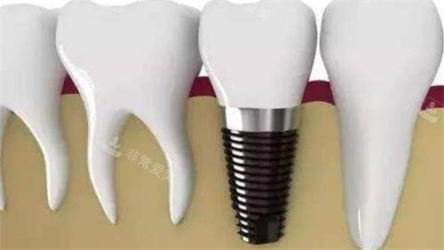 种植牙后效果图