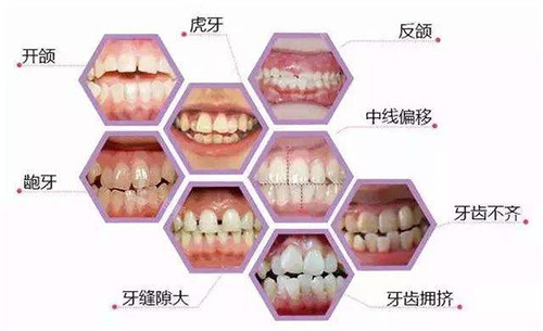 牙齿矫正适应症展示图