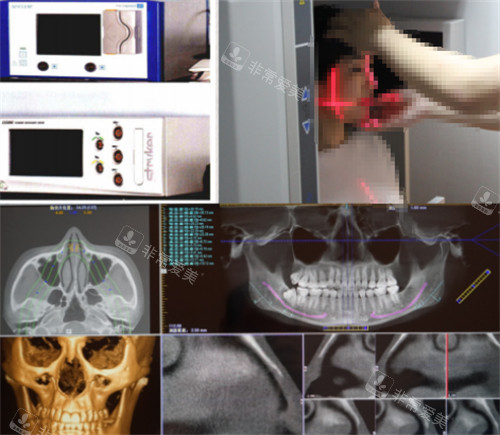 杭州连天美整形高俊明磨骨术前检查