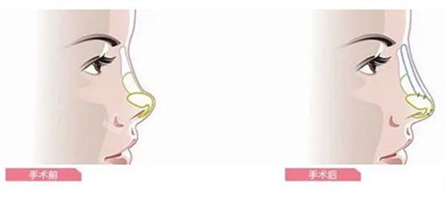 王旭明修复鼻子好吗？...