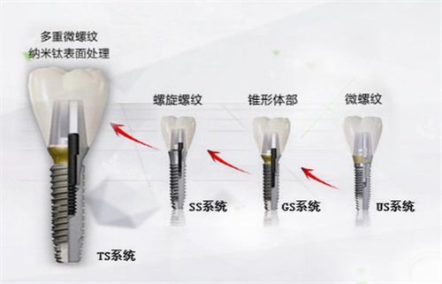韩国奥齿泰种植体型号