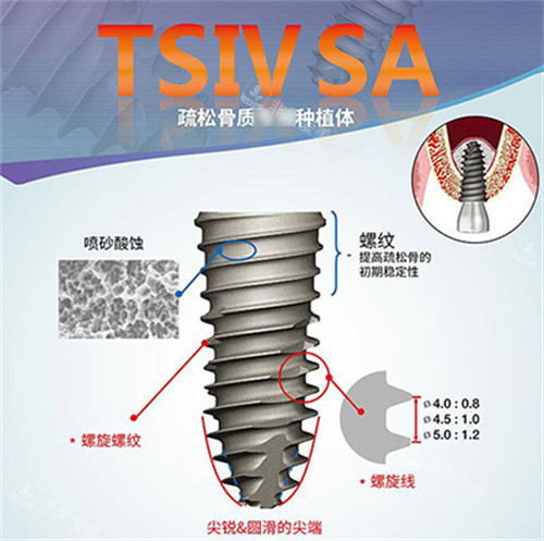 奥齿泰种植牙表面优势
