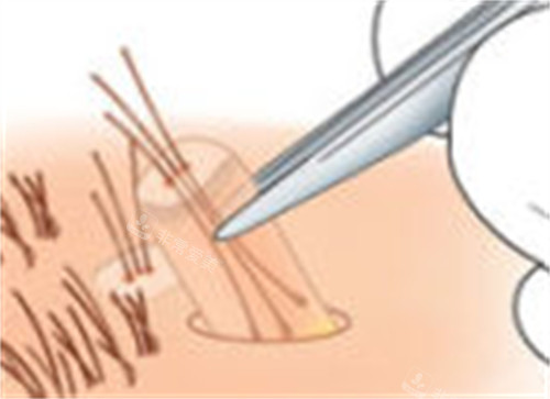 毛发移植的过程图解 毛发移植的过程图解