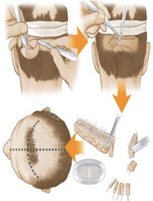 FUT毛发移植演示动画图 FUT毛发移植演示动画图